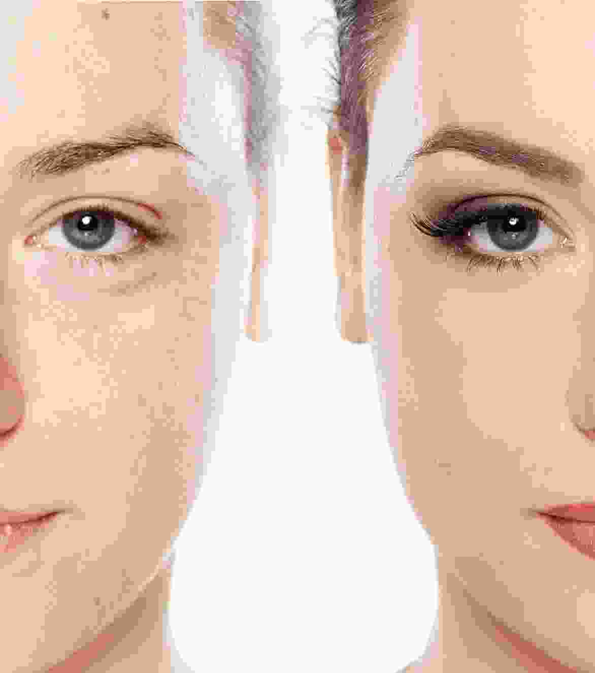 Hair Transplantation